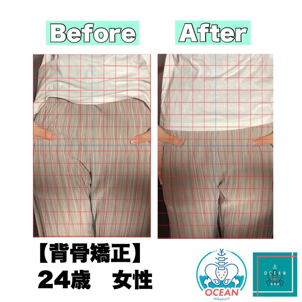 こんにちは🌞OCEAN整骨院です！背骨矯正後の、Before & After ですこのように一回の施術で、効果が得られるのが&