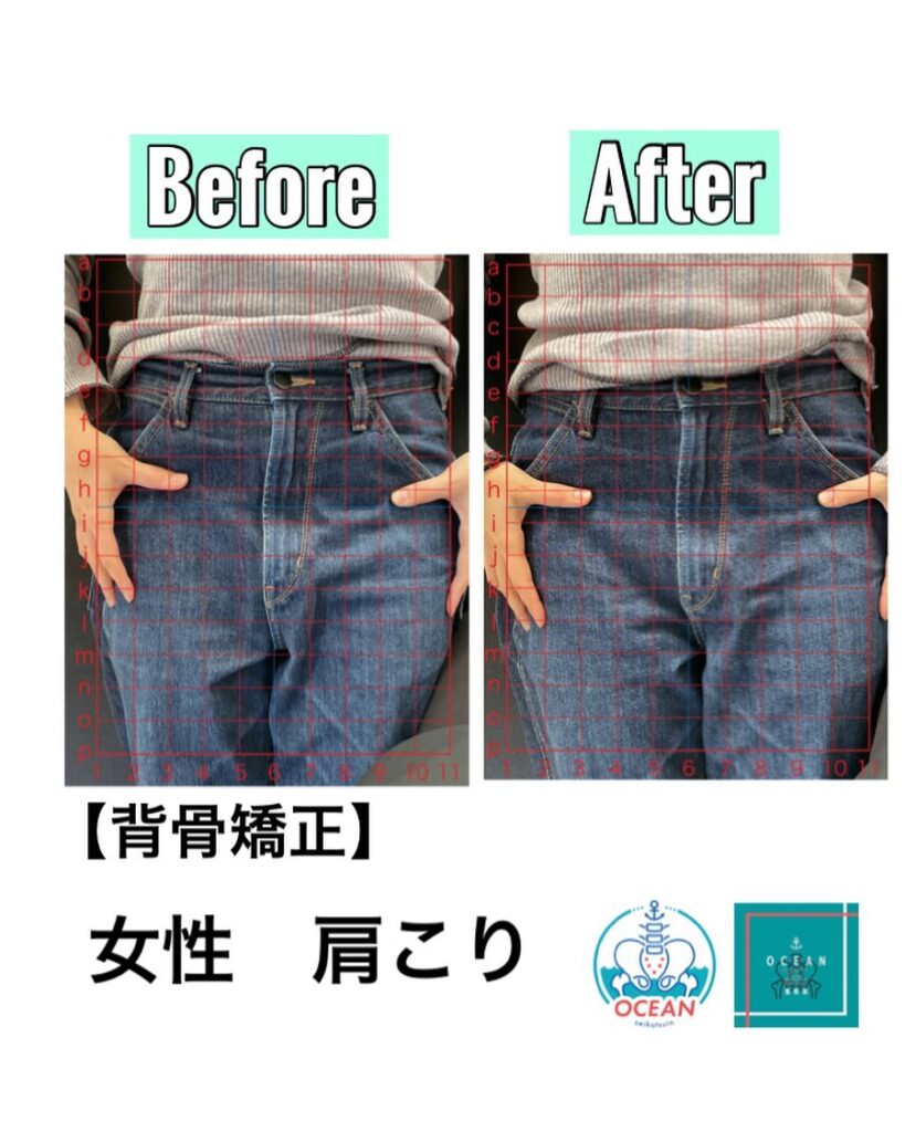 こんにちは！OCEAN整骨院です!当院で1番人気の背骨矯正です🦴「ボキッ」って音は怖い方も多いとは思いますが、基本的には全く痛くありません️どうしても怖くて力が入ってしまうと痛みを伴ってしまいます。