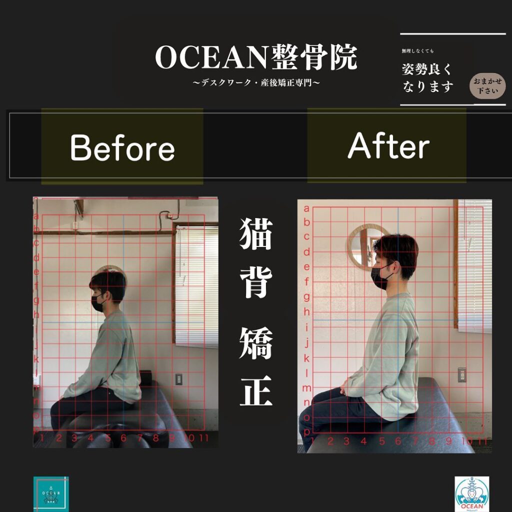 当院のOCEAN式猫背矯正は、基本的には特別なものを使っての施術や、特殊な技などを使った施術ではありませんその方その方の猫背になっている原因の筋肉や神経・関節などに対して適切にアプローチすることにより、施術終了後に患者様より、【え、今のでこんなに変わったの？！】と言われることが多々あります️特別なことをしてない分、体にも負担が少なく安心安全の施術を提供しております！痛みがなくても姿勢の治療は必要です‍♂️痛みがないからこそ姿勢の治療が必要になってきますので、気になる方はご連絡・ご予約お待ちしております4月は既存枠(再診枠)は全て埋まりました！新規枠には空きがございます！お早めのご連絡お待ちしております下記の時間を新規の方限定の時間帯にさせていただきます‍♀️①平日正午12:00~1名②平日午後18:00〜1名③土曜正午12:00〜1名④日曜正午12:00〜1名気になる方は、①インスタDMで予約②インスタ予約欄から予約③公式LINE④電話で予約️LINEに関しましては、インスタプロフィールよりハイライトにてLINEのQRコードがありますご連絡お待ちしております！𓂃𓂂𓋪𓂃𓂂𓂃𓋪𓃉𓂃ํ𓂃𓂂𓂃𓋪𓂃ํ𓂃𓂂𓂃𓂂𓋪𓂃𓃉ํ𓂃𓋪𓂂𓂃ํ𓂂𓂃𓃉𓋪❏ OCEAN整骨院︎ 鹿児島県薩摩川内市五代町1857-3︎ 営業時間: 月〜金 9時〜21時　　　　　　　　土 9時〜18時　　　　　　　　日 9時〜13時︎鹿児島で姿勢矯正・産後矯正ならOCEAN整骨院︎デスクワーク・産後矯正専門