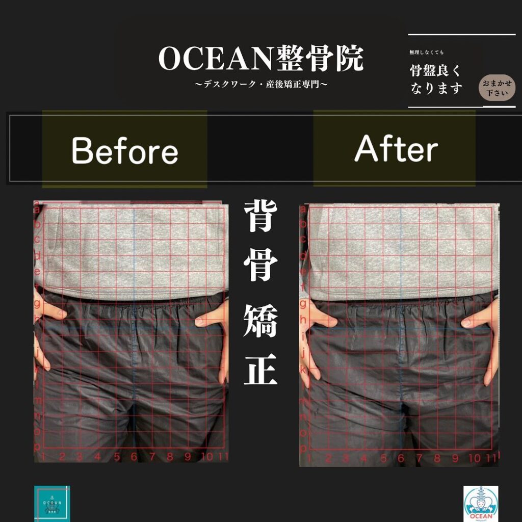 こんにちは！OCEAN整骨院です!当院で1番人気の背骨矯正です🦴「ボキッ」って音は怖い方も多いとは思いますが、基本的には全く痛くありません️どうしても怖くて力が入ってしまうと痛みを伴ってしまいます。