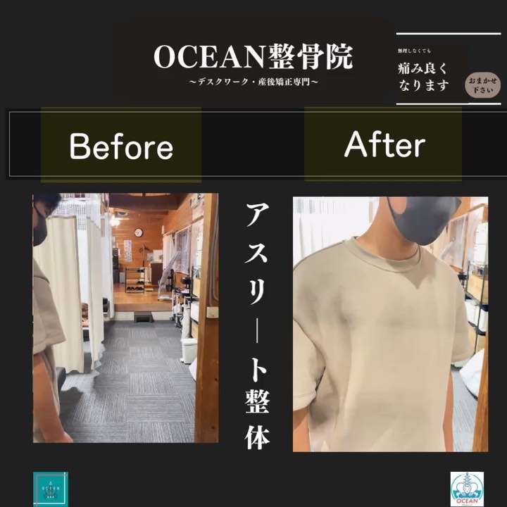 こんにちは！OCEAN整骨院です当院はアスリートケアという形でスポーツしてる学生の治療･ケアをしてます‍♂️この方は病院でジャンパー膝と診断されていたのですが、当院で問診･検査等で【オスグッド・シュラッター病】と判断し施術をしました病態が違えば治療法も違うので、治るものも治らなくなってしまいます🥲整骨院や整形外科に通ってて、痛みがなかなか取れない場合は1度ご相談ください‍♂️5月もほとんどご予約埋まりました‍♂️ご予約の際は、お早めのご連絡お待ちしております下記の時間を新規の方限定の時間帯にさせていただきます‍♀️①平日正午12:00~1名②平日午後18:00〜1名③土曜正午12:00〜1名④日曜正午12:00〜1名また、平日の○月曜11:00〜○金曜11:00〜は新規の産後矯正専用の時間帯となっておりますこの時間は託児スタッフがいます！気になる方は、①インスタDMで予約②インスタ予約欄から予約③公式LINE④電話で予約️LINEに関しましては、インスタプロフィールよりハイライトにてLINEのQRコードがありますご連絡お待ちしております！𓂃𓂂𓋪𓂃𓂂𓂃𓋪𓃉𓂃ํ𓂃𓂂𓂃𓋪𓂃ํ𓂃𓂂𓂃𓂂𓋪𓂃𓃉ํ𓂃𓋪𓂂𓂃ํ𓂂𓂃𓃉𓋪❏ OCEAN整骨院︎ 鹿児島県薩摩川内市五代町1857-3︎ 営業時間: 月〜金 9時〜21時　　　　　　　　土 9時〜18時　　　　　　　　日 9時〜13時︎鹿児島で姿勢矯正・産後矯正ならOCEAN整骨院︎デスクワーク・産後矯正専門
