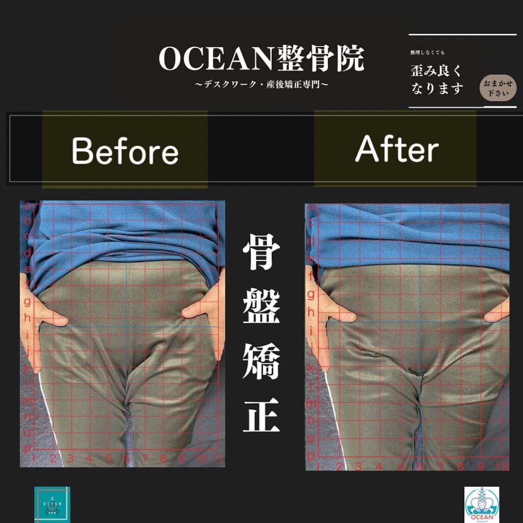 こんにちは！OCEAN整骨院です当院の骨盤矯正は2種類あります患者様の症状や、主訴に合わせて施術致します！ボキボキしない骨盤矯正を行うと施術直後ほとんどの方が足が長くなったと実感されてます骨盤の歪みが気になる方は、1度ご相談ください‍♂️5月もほとんどご予約埋まりました‍♂️ご予約の際は、お早めのご連絡お待ちしております下記の時間を新規の方限定の時間帯にさせていただきます‍♀️①平日正午12:00~1名②平日午後18:00〜1名③土曜正午12:00〜1名④日曜正午12:00〜1名また、平日の○月曜11:00〜○金曜11:00〜は新規の産後矯正専用の時間帯となっておりますこの時間は託児スタッフがいます！気になる方は、①インスタDMで予約②インスタ予約欄から予約③公式LINE④電話で予約️LINEに関しましては、インスタプロフィールよりハイライトにてLINEのQRコードがありますご連絡お待ちしております！𓂃𓂂𓋪𓂃𓂂𓂃𓋪𓃉𓂃ํ𓂃𓂂𓂃𓋪𓂃ํ𓂃𓂂𓂃𓂂𓋪𓂃𓃉ํ𓂃𓋪𓂂𓂃ํ𓂂𓂃𓃉𓋪❏ OCEAN整骨院︎ 鹿児島県薩摩川内市五代町1857-3︎ 営業時間: 月〜金 9時〜21時　　　　　　　　土 9時〜18時　　　　　　　　日 9時〜13時︎鹿児島で姿勢矯正・産後矯正ならOCEAN整骨院︎デスクワーク・産後矯正専門