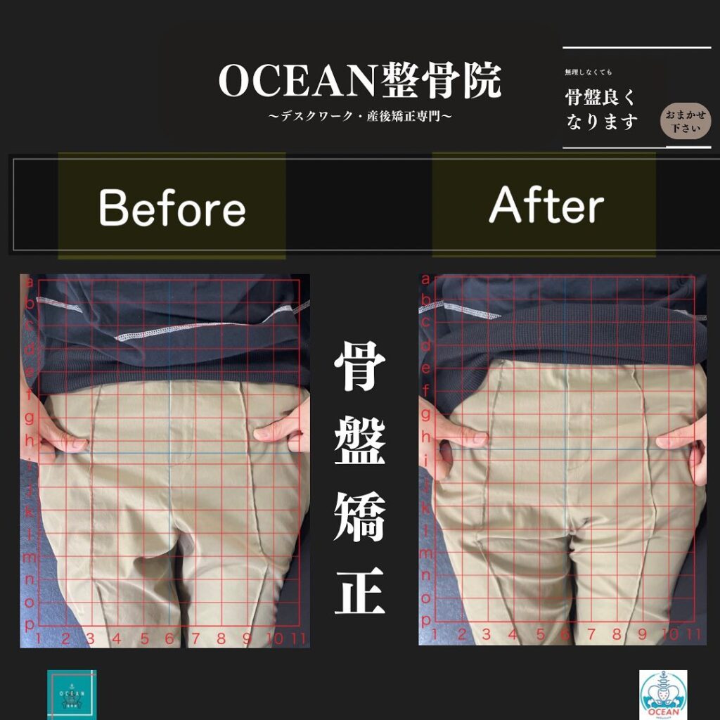 こんにちは！OCEAN整骨院です!当院で人気の骨盤矯正です🦴家族や友達、仕事の上司、同期や後輩で体の不調でお困りの方がいらっしゃいましたら、是非ご紹介下さいきっとお力になれると思います🤝その他施術についてや、分からないこと等あればいつでもご連絡お待ちしております‍♂️‍♀️下記の時間を新規の方限定の時間帯にさせていただきます‍♀️①平日正午12:00~1名②平日午後18:00〜1名③土曜正午12:00〜1名④日曜正午12:00〜1名下記曜日、時間は産後の患者様優先時間となっております！○月曜日 9:00~13:00○金曜日9:00~13:00この時間でのご予約は託児スタッフが大事なお子様をお預かり致します※託児料は発生しません。