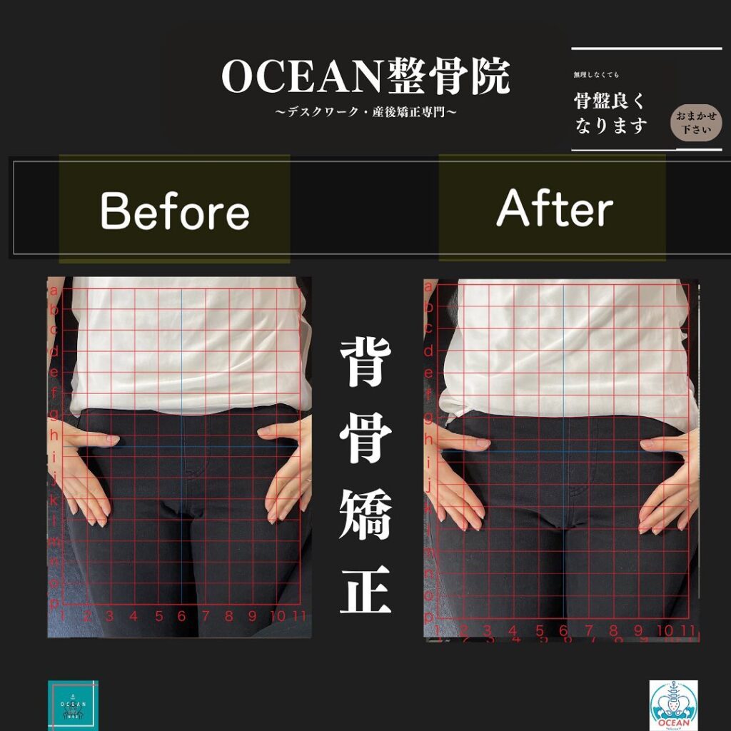こんにちは！OCEAN整骨院です!当院で1番人気の背骨矯正です🦴「ボキッ」って音は怖い方も多いとは思いますが、基本的には全く痛くありません️どうしても怖くて力が入ってしまうと痛みを伴ってしまいます。