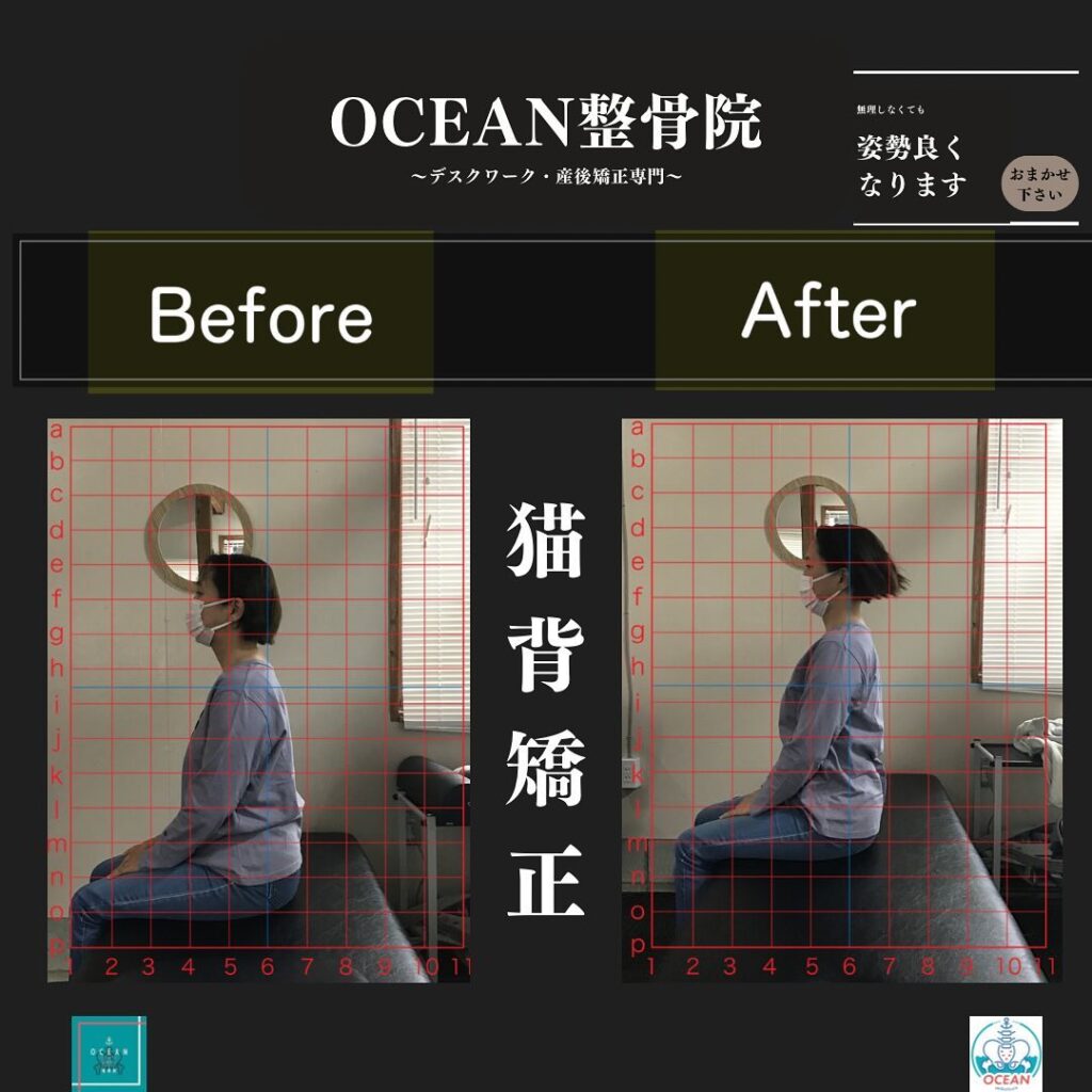 当院のOCEAN式猫背矯正は、基本的には特別なものを使っての施術や、特殊な技などを使った施術ではありませんその方その方の猫背になっている原因の筋肉や神経・関節などに対して適切にアプローチすることにより、施術終了後に患者様より、【え、今のでこんなに変わったの？！】と言われることが多々あります️特別なことをしてない分、体にも負担が少なく安心安全の施術を提供しております！痛みがなくても姿勢の治療は必要です‍♂️痛みがないからこそ姿勢の治療が必要になってきますので、気になる方はご連絡・ご予約お待ちしております下記の時間を新規の方限定の時間帯にさせていただきます‍♀️①平日正午12:00~1名②平日午後18:00〜1名③土曜正午12:00〜1名④日曜正午12:00〜1名下記曜日、時間は産後の患者様優先時間となっております！○月曜日 9:00~13:00○金曜日9:00~13:00この時間でのご予約は託児スタッフが大事なお子様をお預かり致します※託児料は発生しません。
