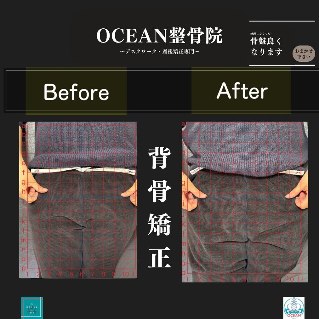 こんにちは！OCEAN整骨院です!当院で1番人気の背骨矯正です🦴「ボキッ」って音は怖い方も多いとは思いますが、基本的には全く痛くありません️どうしても怖くて力が入ってしまうと痛みを伴ってしまいます。
