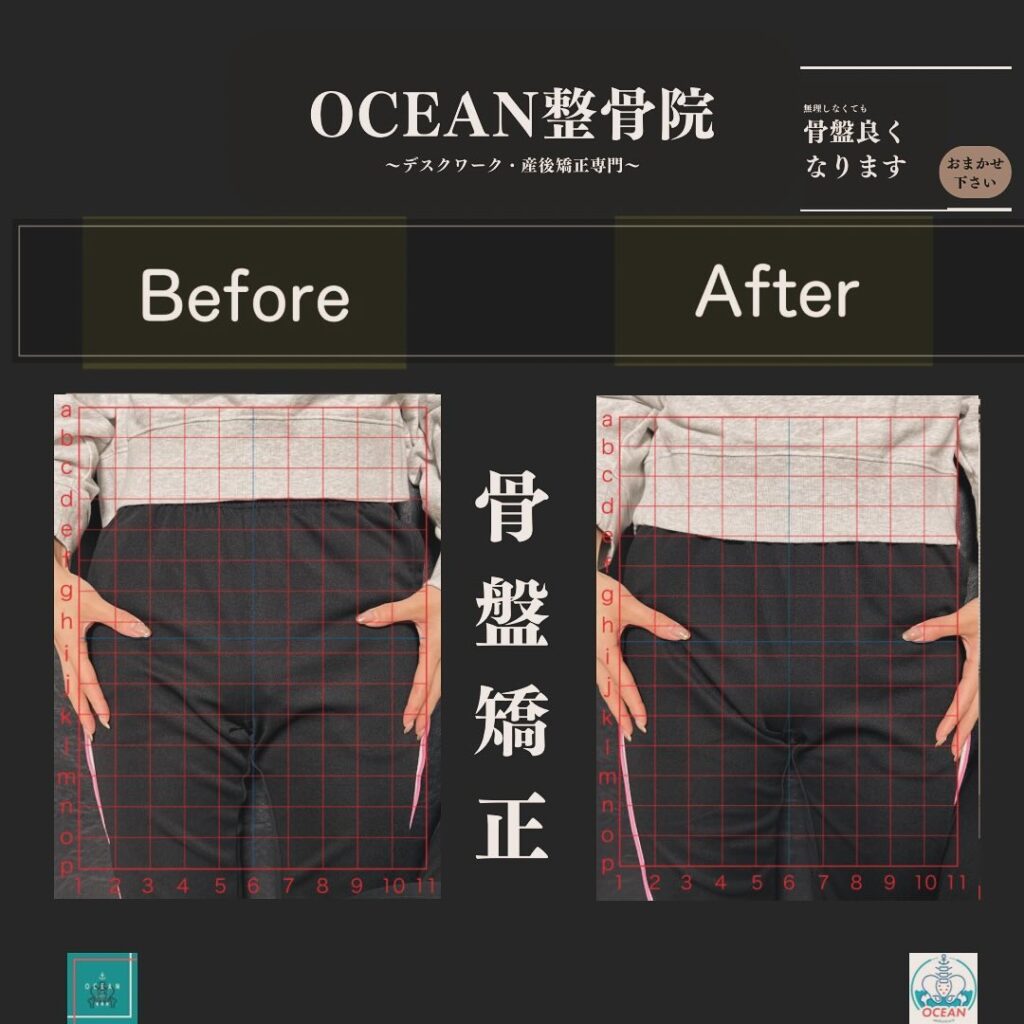 こんにちは！OCEAN整骨院です!当院で人気の骨盤矯正です🦴家族や友達、仕事の上司、同期や後輩で体の不調でお困りの方がいらっしゃいましたら、是非ご紹介下さいきっとお力になれると思います🤝その他施術についてや、分からないこと等あればいつでもご連絡お待ちしております‍♂️‍♀️下記の時間を新規の方限定の時間帯にさせていただきます‍♀️①平日正午12:00~1名②平日午後18:00〜1名③土曜正午12:00〜1名④日曜正午12:00〜1名下記曜日、時間は産後の患者様優先時間となっております！○月曜日 9:00~13:00○金曜日9:00~13:00この時間でのご予約は託児スタッフが大事なお子様をお預かり致します※託児料は発生しません。