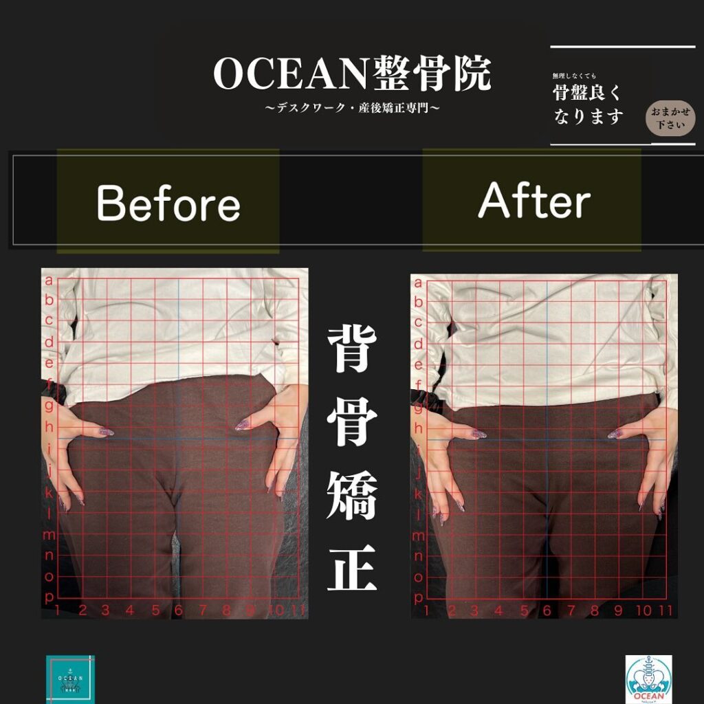 こんにちは！OCEAN整骨院です!当院で1番人気の背骨矯正です🦴「ボキッ」って音は怖い方も多いとは思いますが、基本的には全く痛くありません️どうしても怖くて力が入ってしまうと痛みを伴ってしまいます。