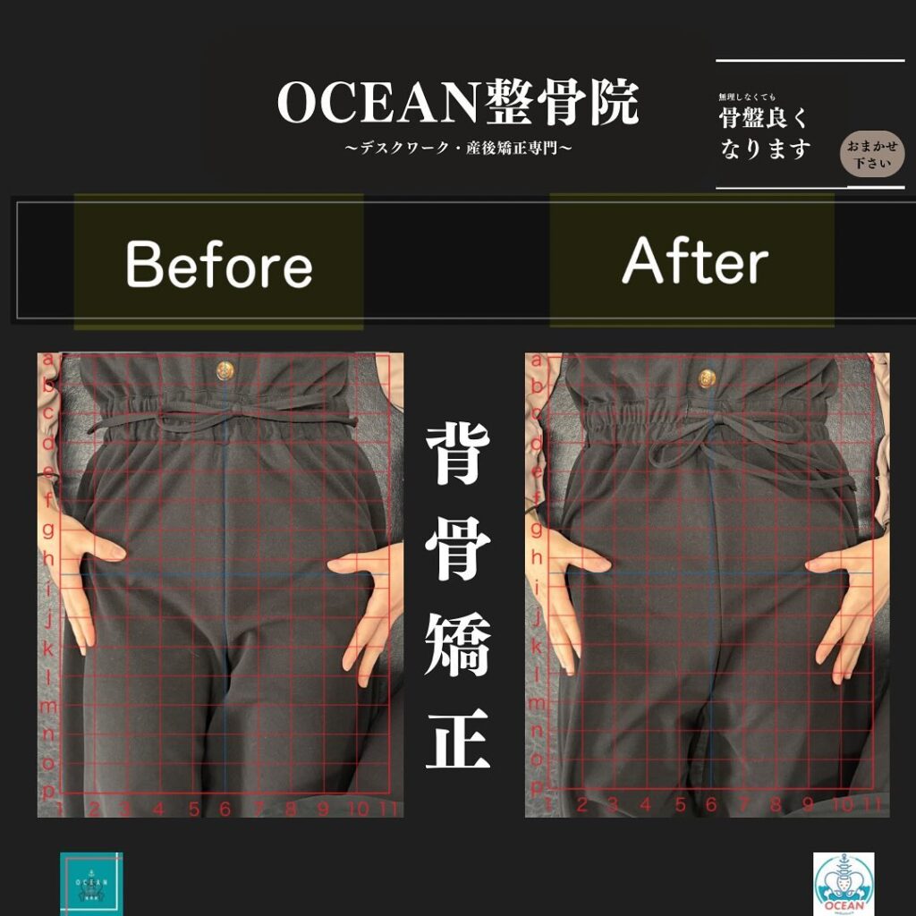 こんにちは！OCEAN整骨院です!当院で1番人気の背骨矯正です🦴「ボキッ」って音は怖い方も多いとは思いますが、基本的には全く痛くありません️どうしても怖くて力が入ってしまうと痛みを伴ってしまいます。